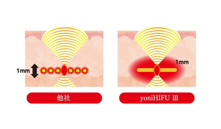 膣ハイフ｜坂本レディースクリニック