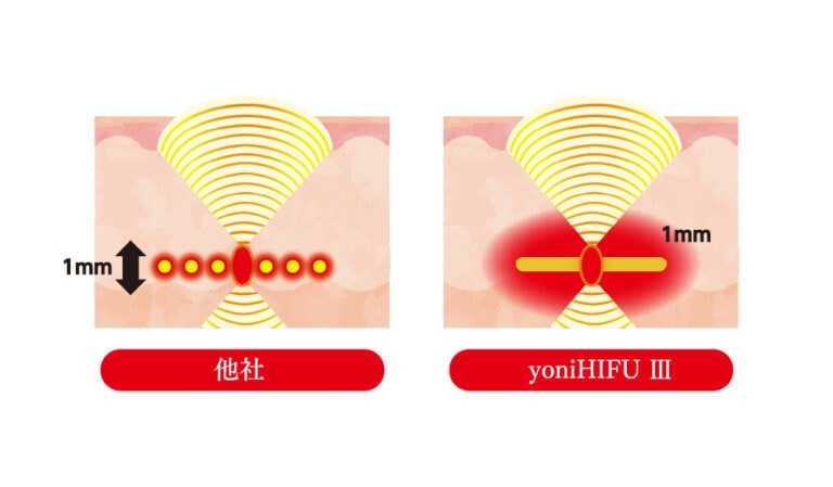 業務用美容機器 ハイフ 膣ハイフ【お値下げ交渉可】